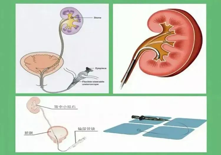医疗动态输尿管软镜钬激光碎石术碎石了无痕