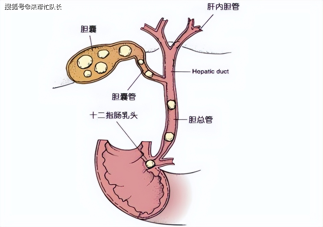 关于胆管炎你了解多少急性胆管炎和慢性胆管炎有什么区别