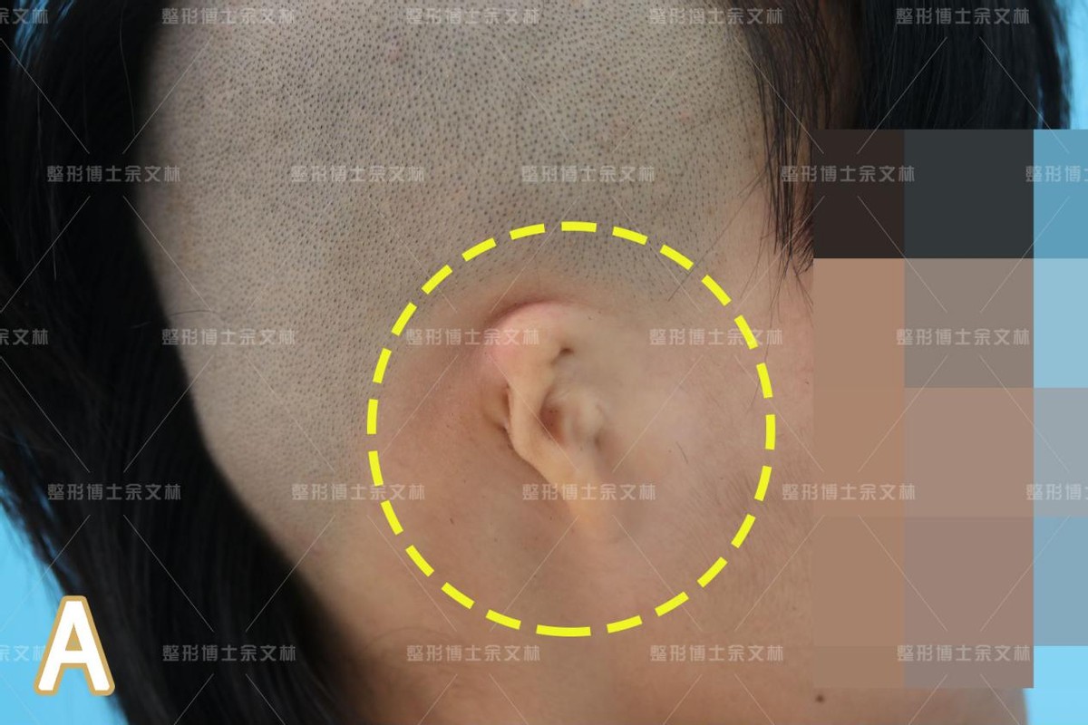 案例分析右侧腊肠型小耳畸形扩张法耳再造术后分享