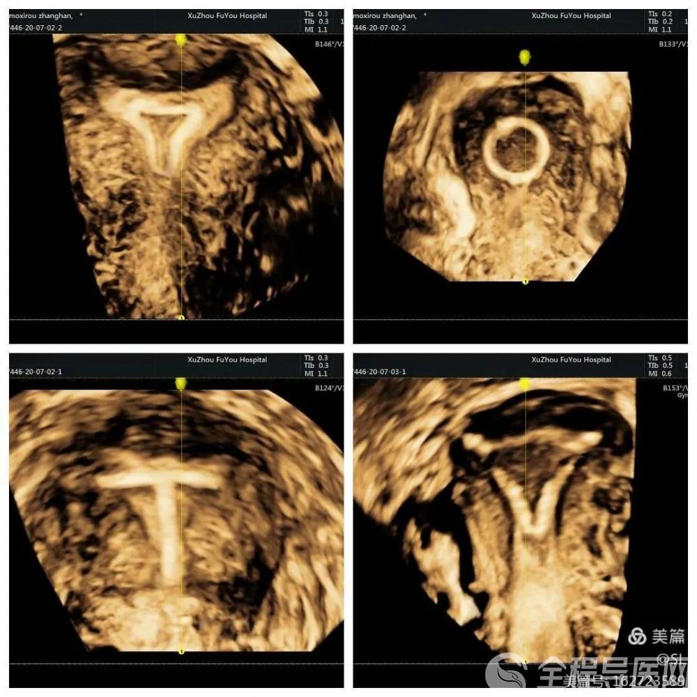 怀女孩三维彩超图图片