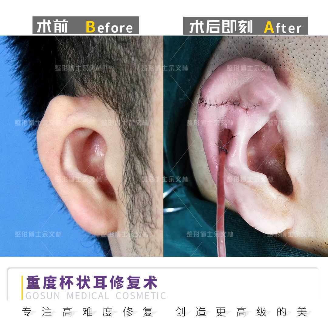 杯状耳怎么矫正盘点杯状耳矫正手术的几种常用方法