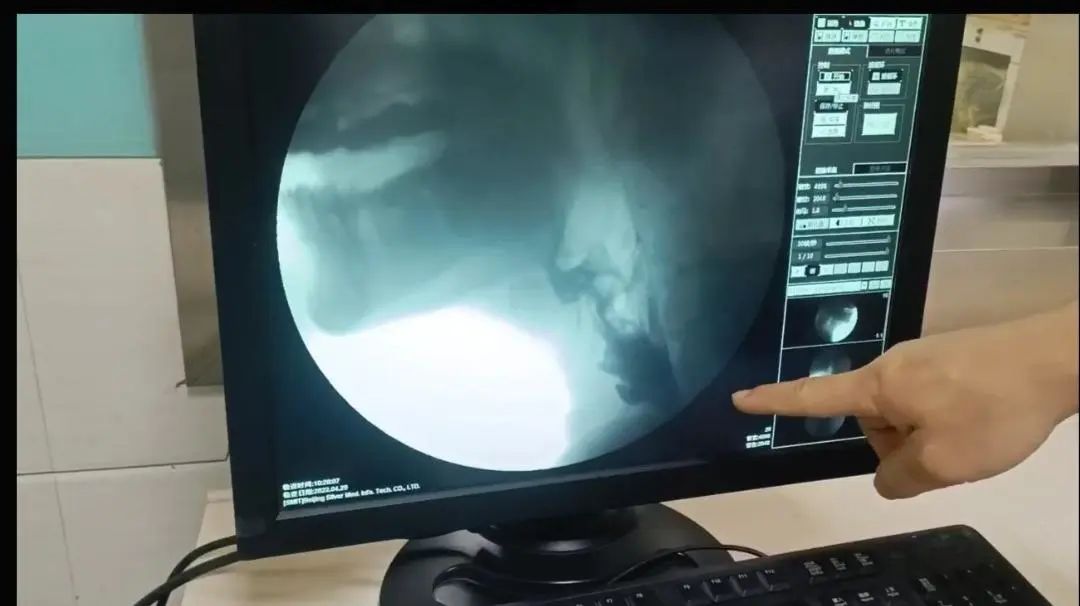 宝鸡第三医院成功开展首例吞咽造影检查术