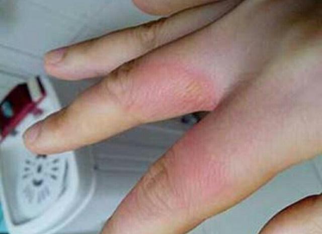 2块钱的红霉素软膏竟是皮肤万能药提醒滥用可致3大后果