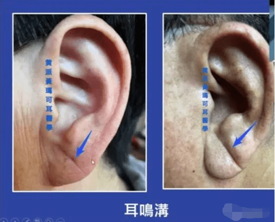 运用耳廓诊病“耳诊”(高清耳图)_耳朵_耳穴_颈椎