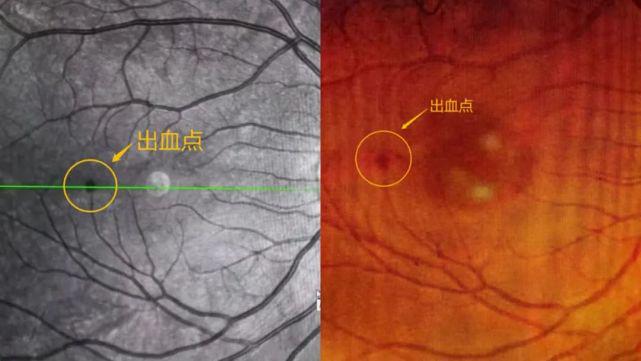 運動太猛眼底出血超600度的高度近視如何健身寧波眼科醫生解答