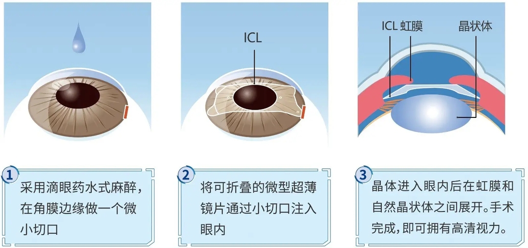 哪種條件可以做晶體近視手術重慶眼科近視手術醫院排名icl晶體價格