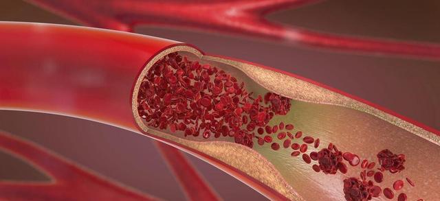 血栓“大户”或被发现，肥肉未上榜，医生：多吃或不利于血管健康