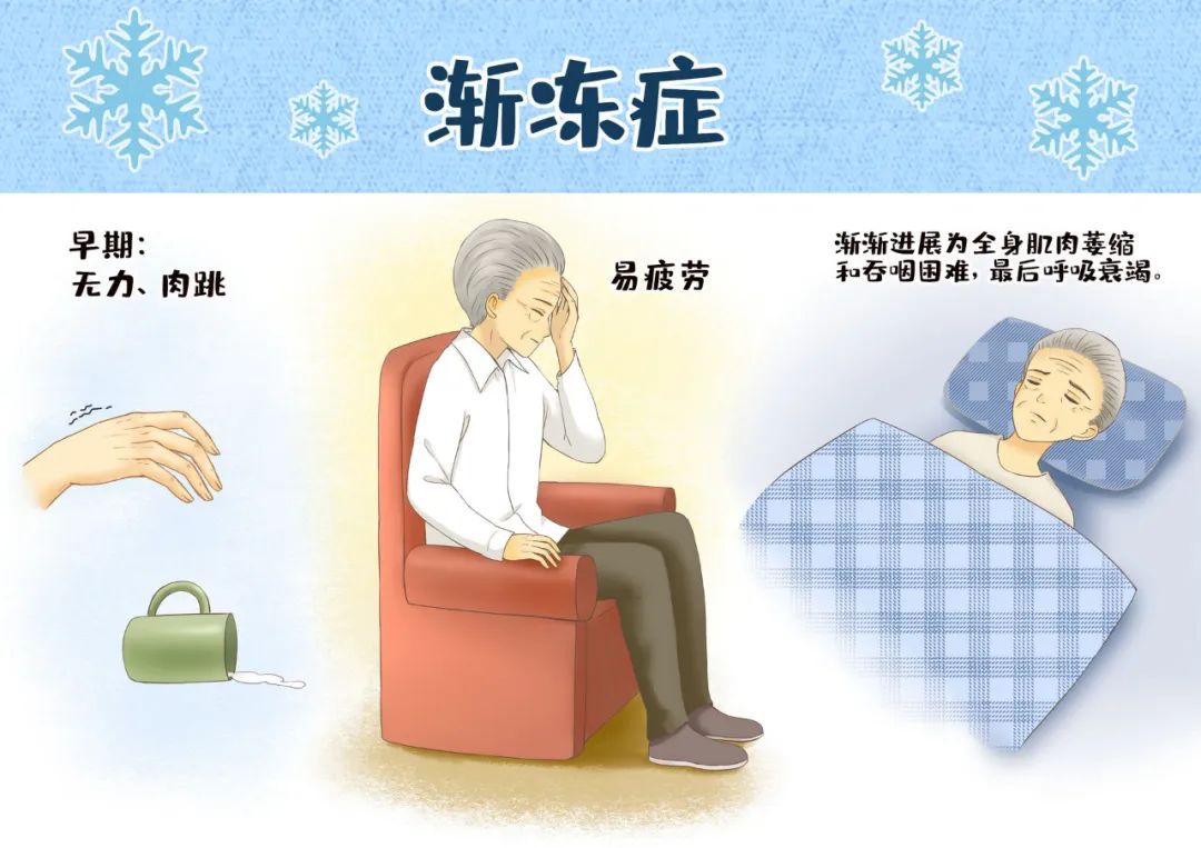 渐冻症的发病过程是怎样的如何及早发现初期端倪