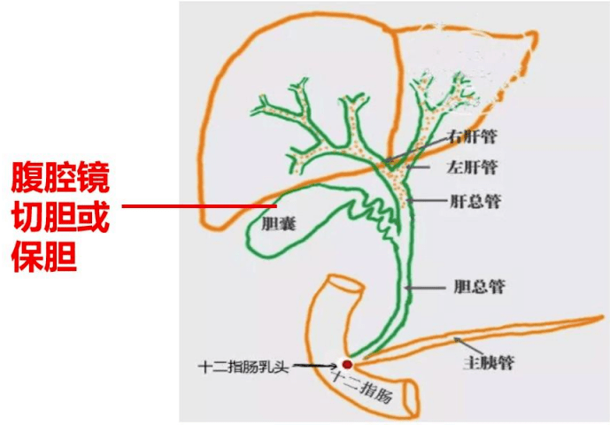胆囊疾病,这是我见过的最好的科普了(强烈推荐)_功能_保胆_患者