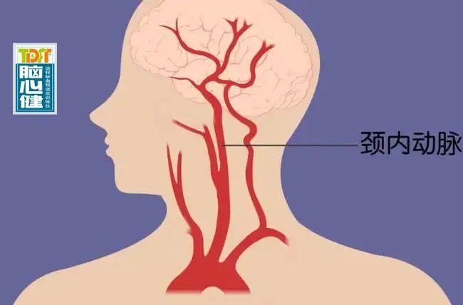 治疗颈动脉斑块最有效的药方_颈动脉斑块最新特效药_中药颈部动脉斑块治疗方法