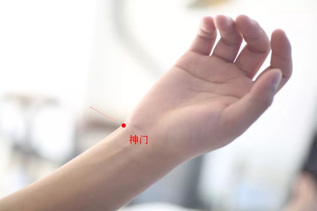 镇静安神针法治疗失眠