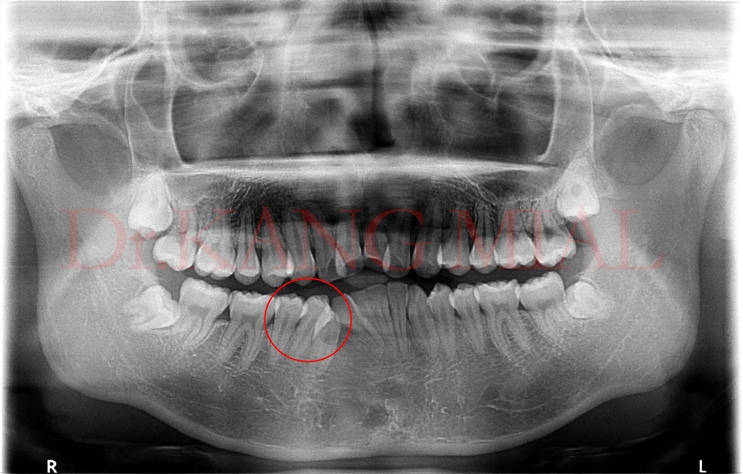 正常牙齿侧面x光片图片