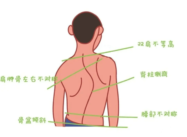 直乐大讲堂:高低肩,不只是肩不平_肩膀_脊柱_肌肉