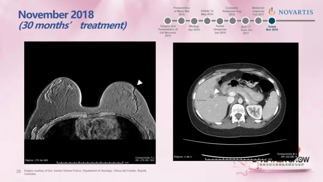 中外专家对话聚焦hrher2晚期年轻乳腺癌患者临床研究与治疗