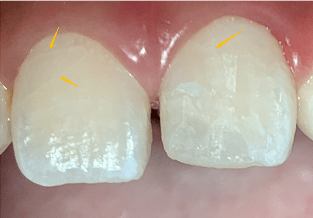 18岁前不能再用门牙吃东西!儿子的这一跤摔得有点惨痛_碎片_医生_牙齿