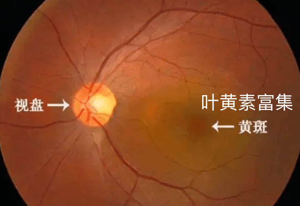 叶黄素到底要不要吃孩子吃了能预防近视吗