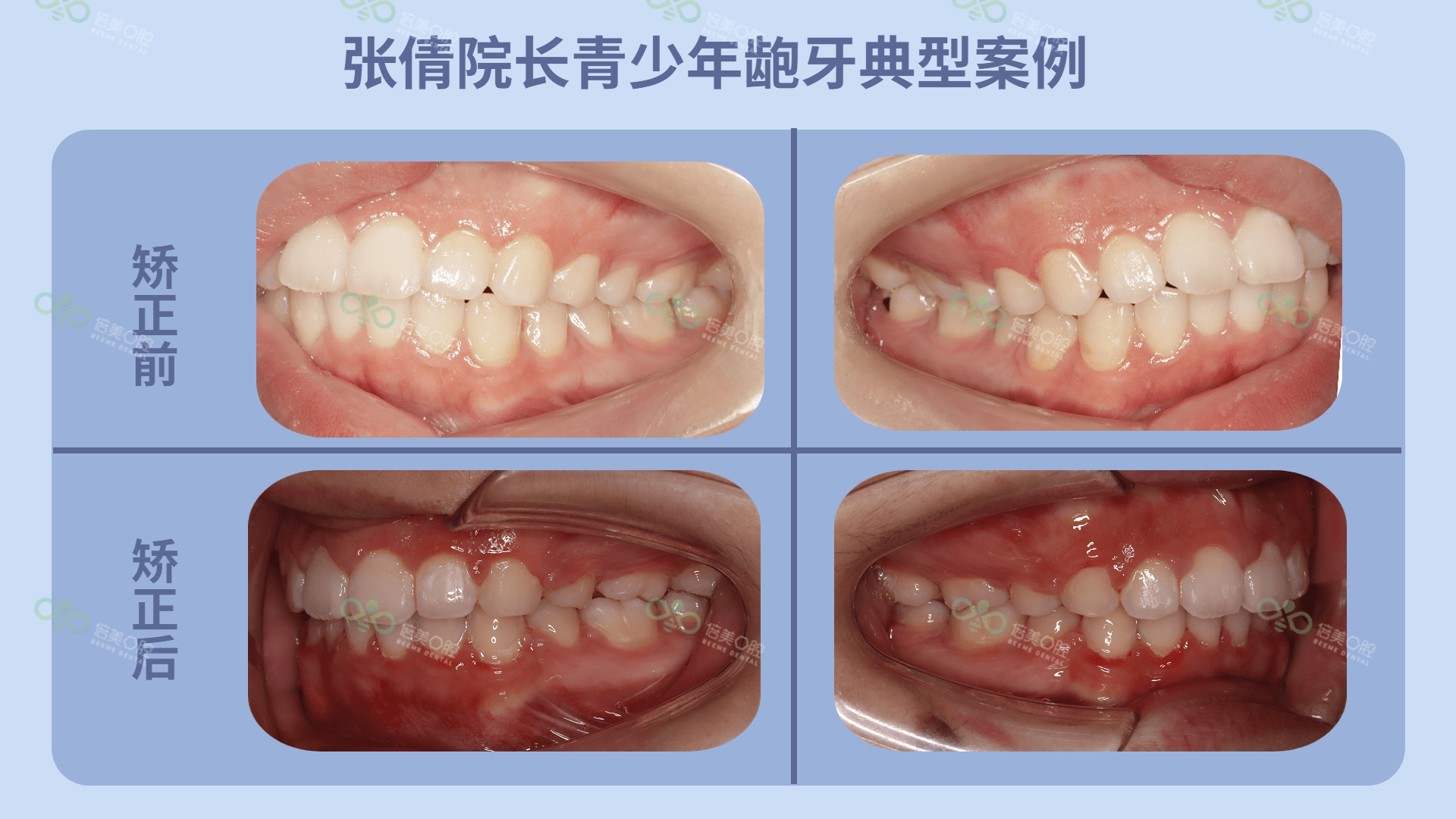 凸嘴牙齿矫正效果图图片