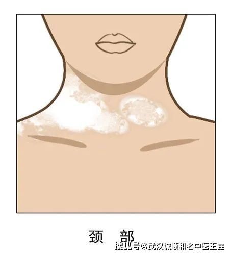 常可见病发部位出现粉红或白色斑块,白斑表面光滑不起屑,在强烈阳光