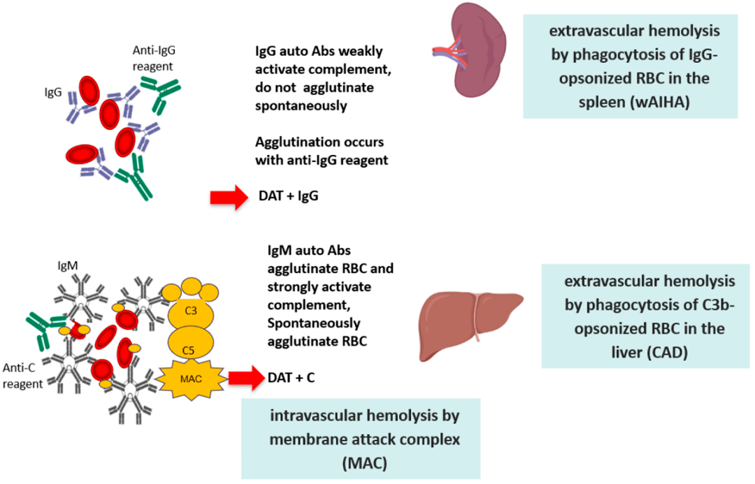 从发病机制到治疗new insights in autoimmune hemolytic anemia