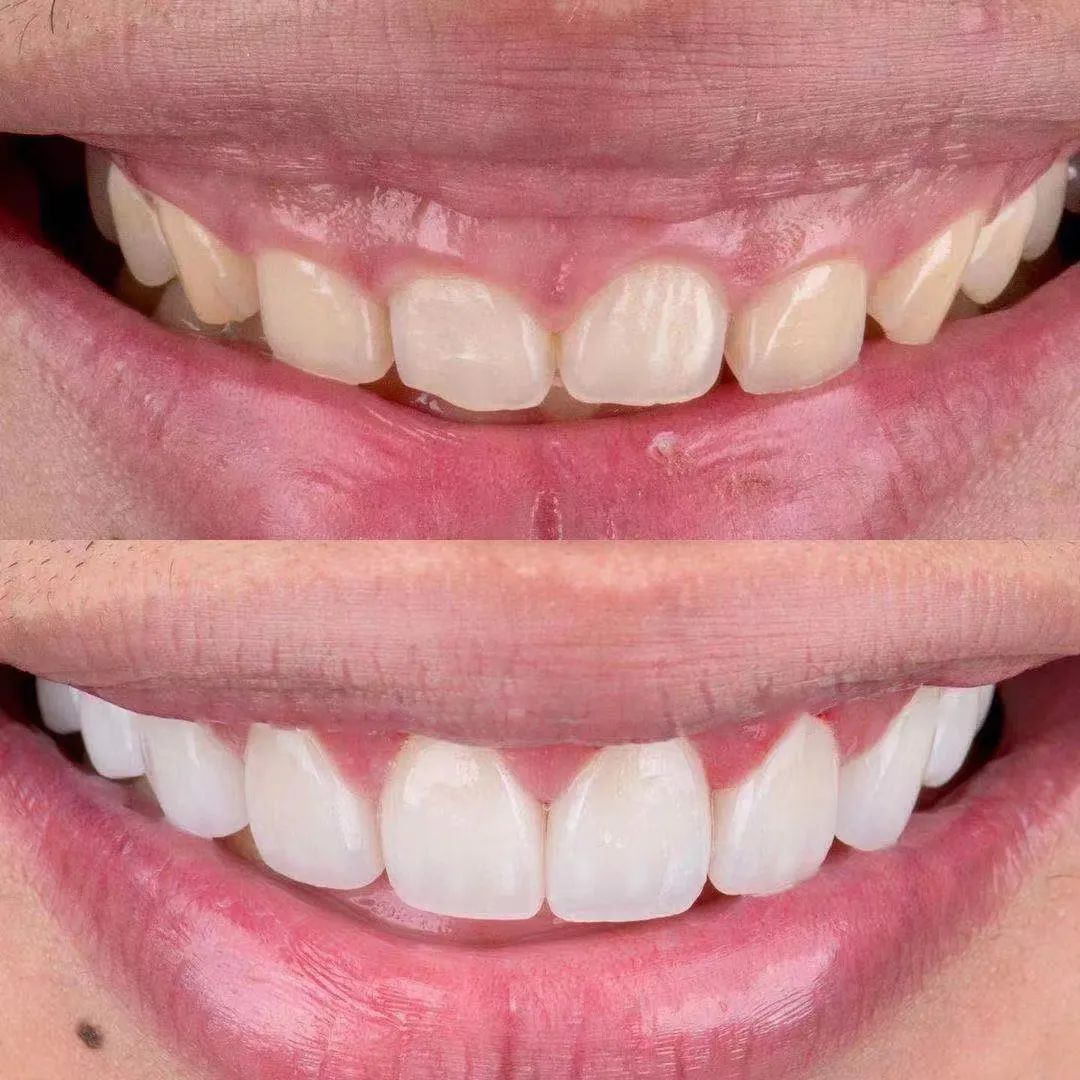四环素牙的病因及树脂遮盖、漂白治疗 - 口腔医学 - 天山医学院