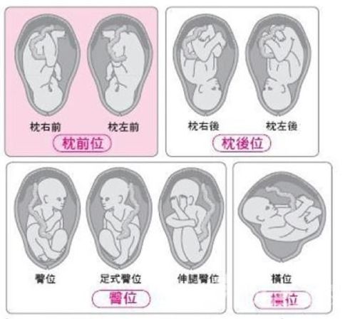 胎位有哪几种图解图片