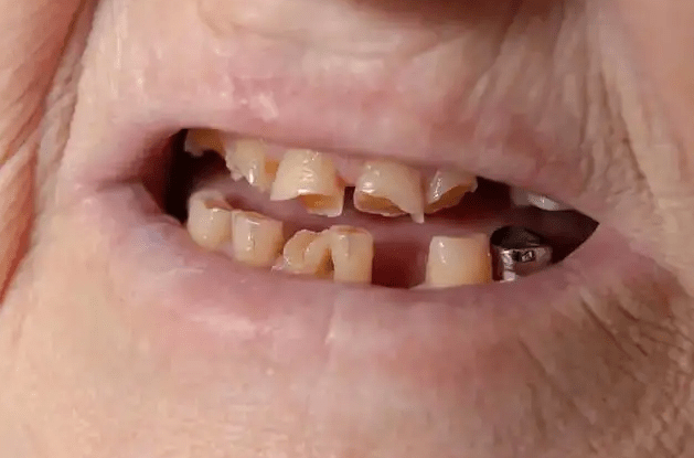 仔细观察,老人家的牙齿,大都逃不过这3个问题_磨损_牙龈_保护