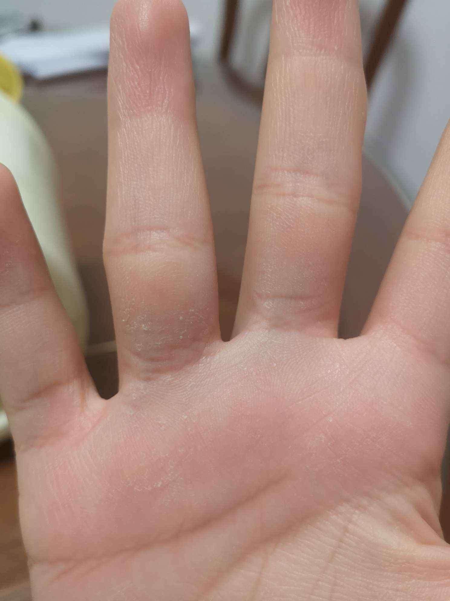手指头脱皮是怎么回事不疼不痒