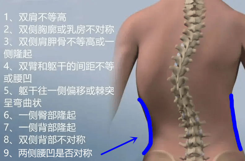 脊柱侧弯已纳入学生体检,自家娃是否真挺直腰杆了？家长仔细检查