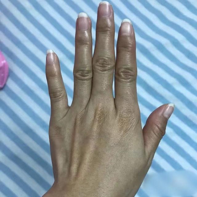 手部皮肤黑怎么变白跟着成功人的脚步准没错