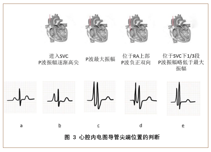 文献汇总腔内心电图定位ecg技术在输液港导管尖端定位中的应用二