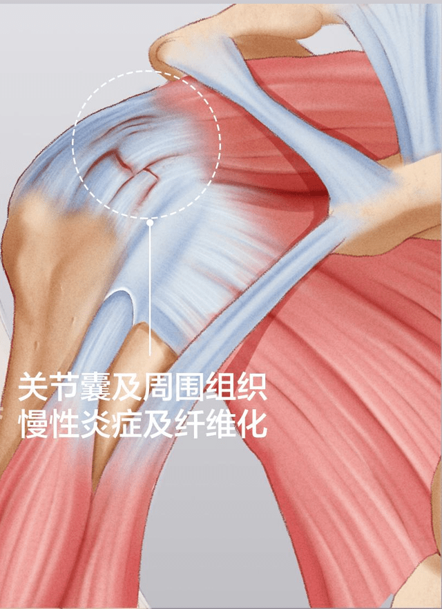 肩颈粘连图片图片