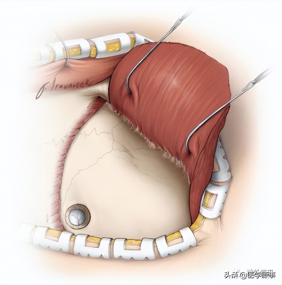 翼点入路操作技巧(pterional craniotomy)