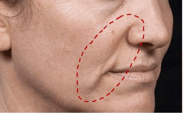 郑在佑医生为您解答:为什么会出现羊腮脸?怎么解决?_面部_口角_脂肪