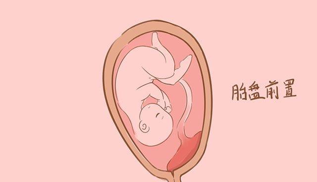 筛查胎宝贝畸形最关键的3次b超,尤其是第二次,事关胎儿性命