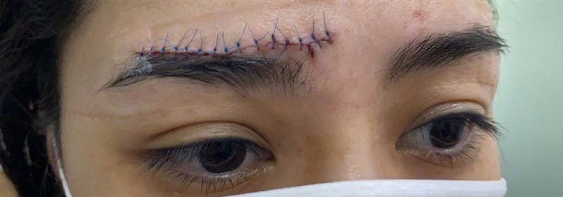 摔破头缝66针,阿娇摔伤后自拍照片曝光额头,伤口看不出来_影片_大洞