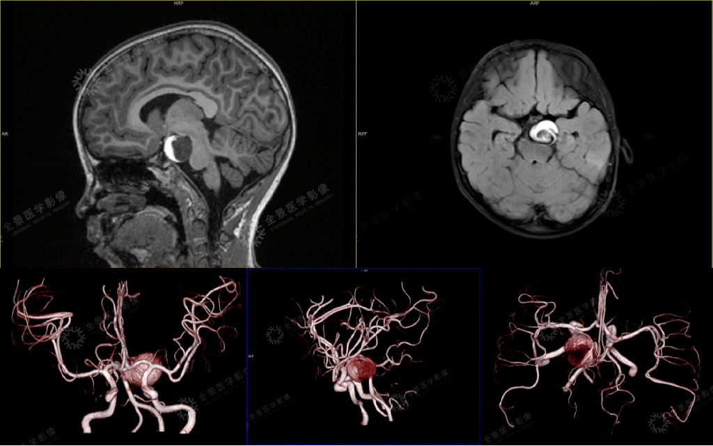 电离辐射,使用tof(时间飞行技术)不需注射对比剂即可获得清晰血管影像
