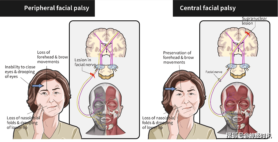 中枢性面瘫与周围性面瘫如何鉴别这4点要知道