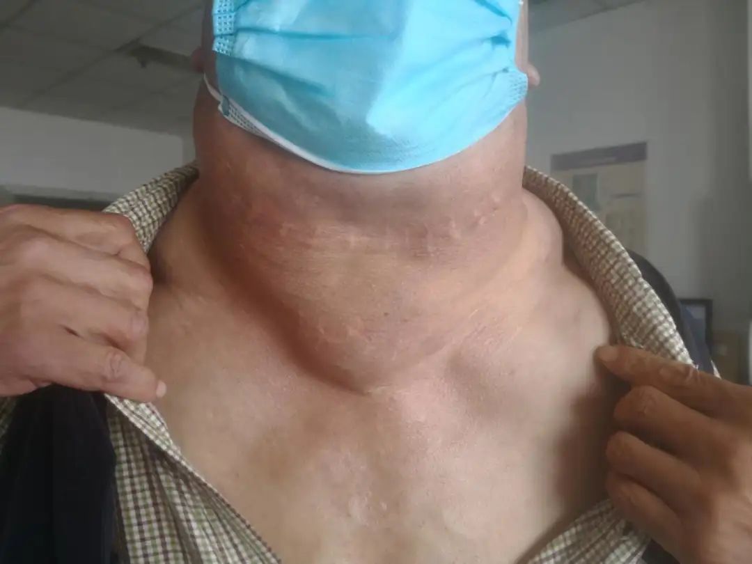 马德龙综合征 来自搜狐网