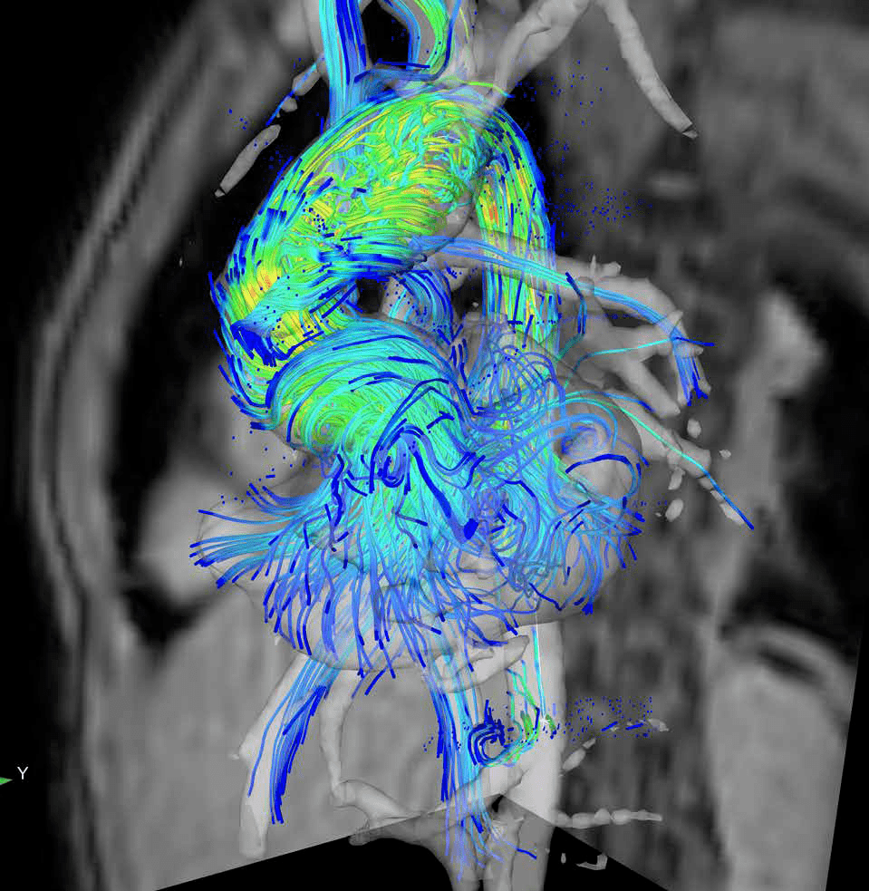 "模型提供了整个心动周期中,每个解剖部位全面的血流动力学信息.