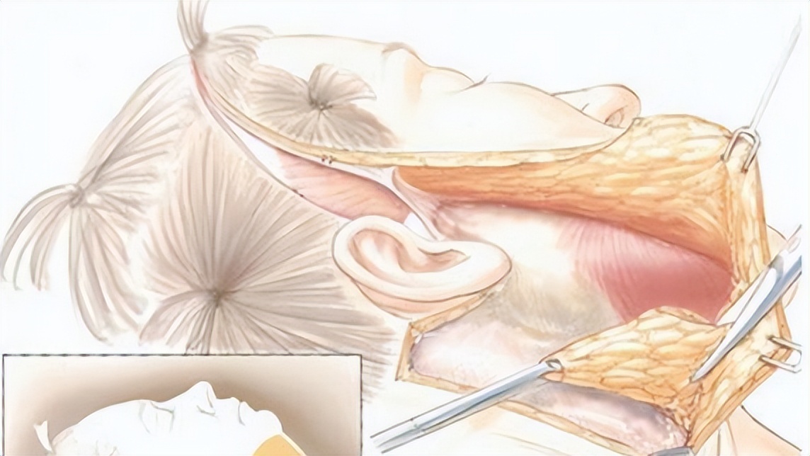 拉皮手术价格一览表拉皮一次能维持多久看完就懂不踩雷