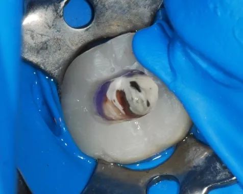 韩国五星橡皮障使用优点介绍_治疗_操作_口腔