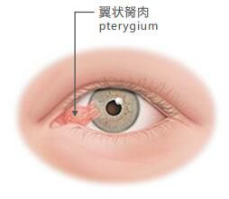 爱眼小讲堂翼状胬肉