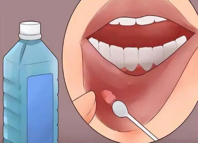 【口腔溃疡的治疗方法】口腔溃疡的原因_口腔溃疡吃什么维生素