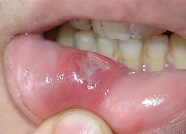 口腔溃疡是怎么引起的呢?与多种因素相关