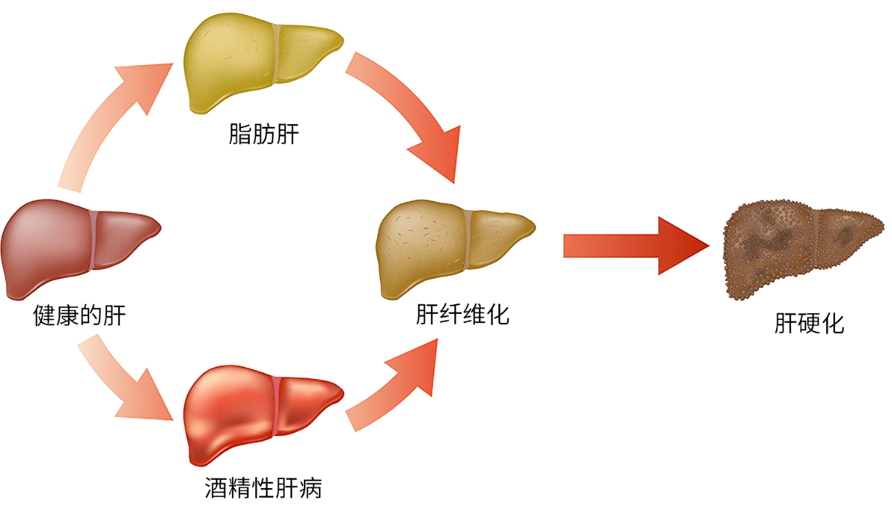 脂肪肝