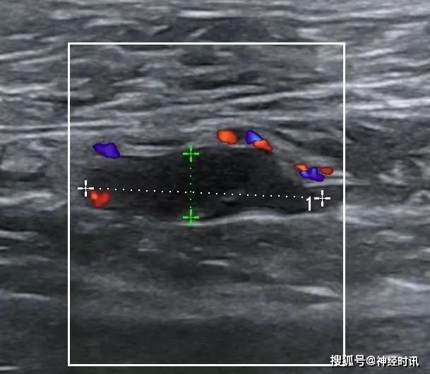 肌間靜脈血栓要不要低分子肝素抗凝