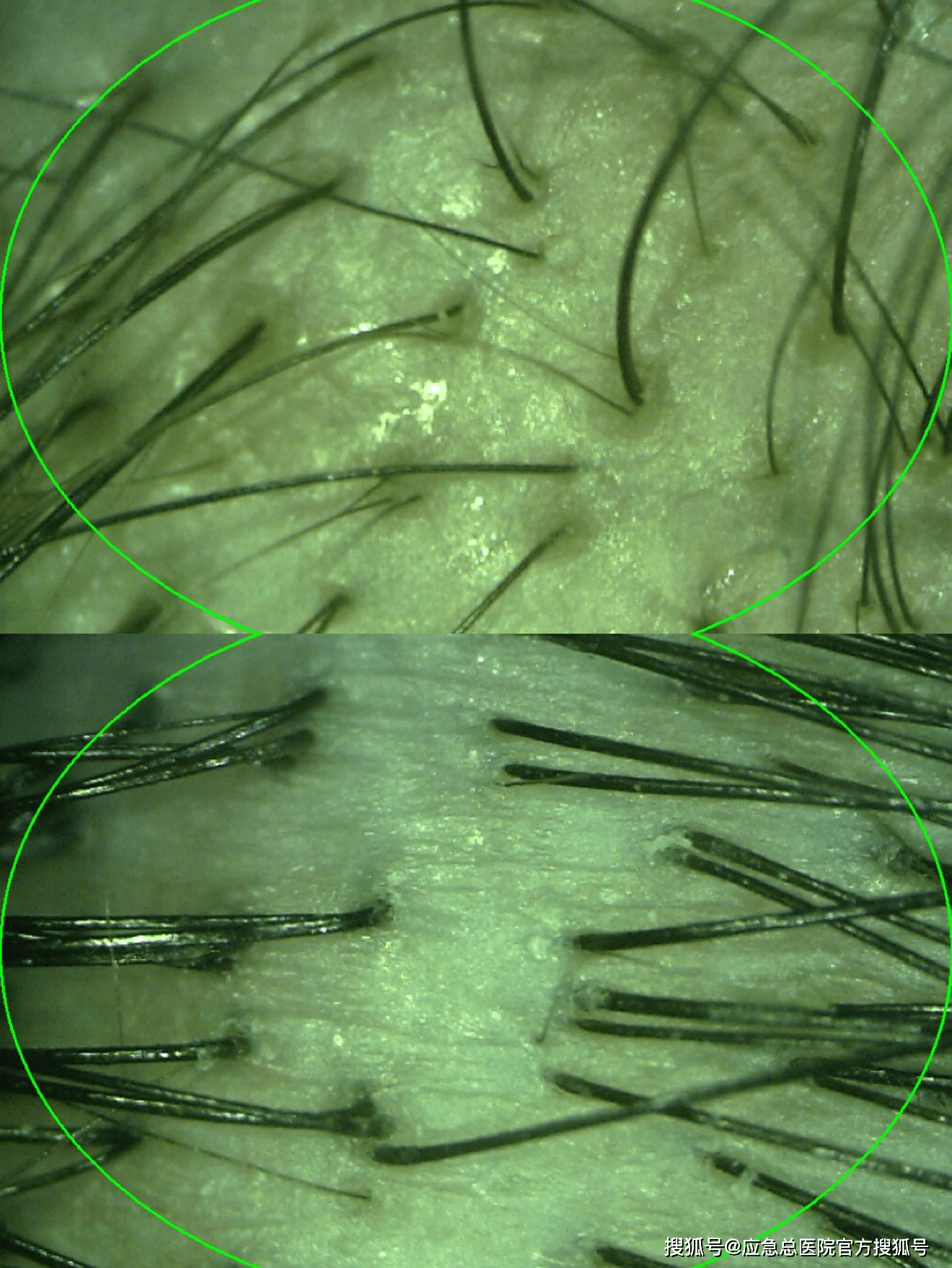 图为临床中同一aga患者在相同放大倍数下头顶部毛囊与后枕部毛囊的