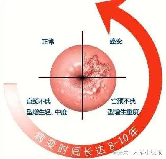 38岁的宝妈，宫颈癌晚期，给所有女性敲响警钟！