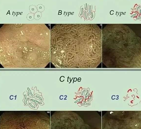 腸鏡能觀察到直腸,全部結腸以及迴腸末端的腸粘膜情況.3.