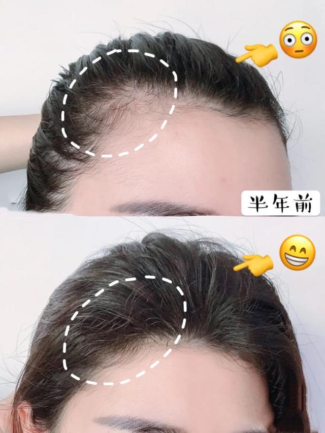 夏天掉头发特别厉害什么原因女性头顶头发稀少需要植发吗